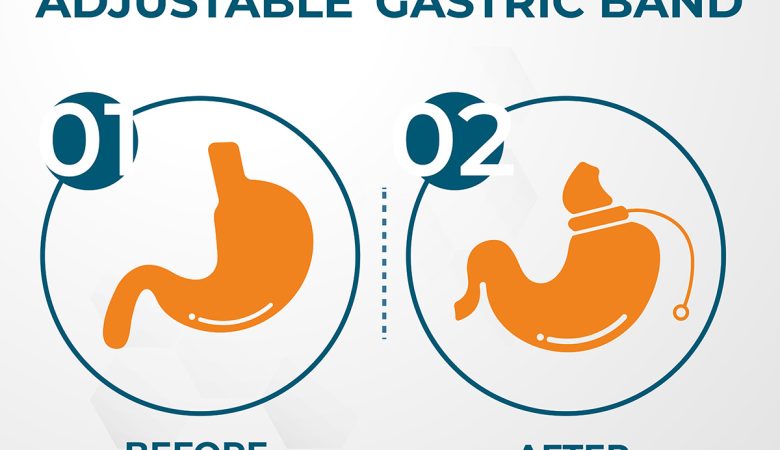 Comparison of the Bariatric Procedures