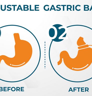 Comparison of the Bariatric Procedures